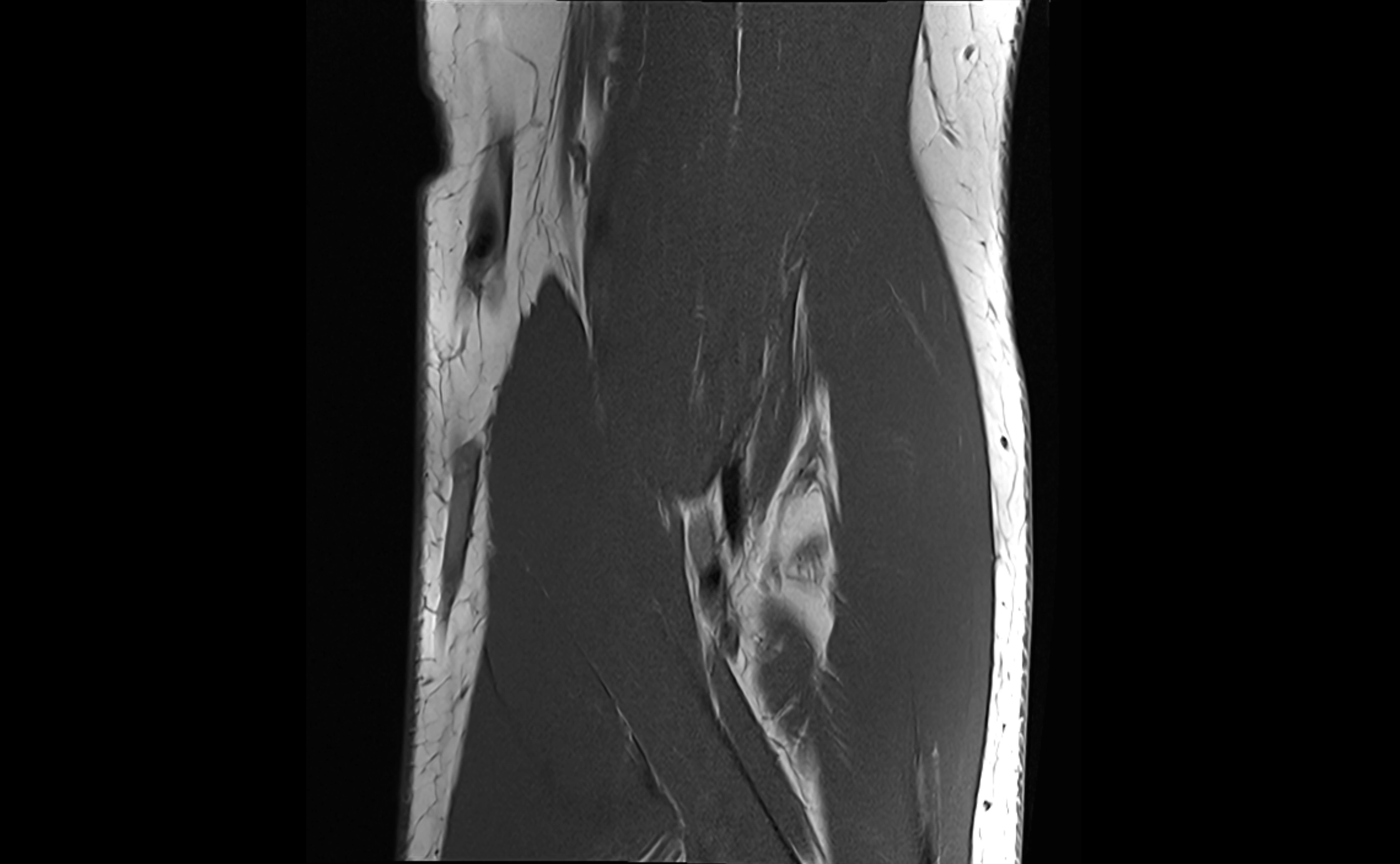 MRI elbow ligaments coronal cross sectional anatomy 3T  radiology  image-img-07001-00012.webp